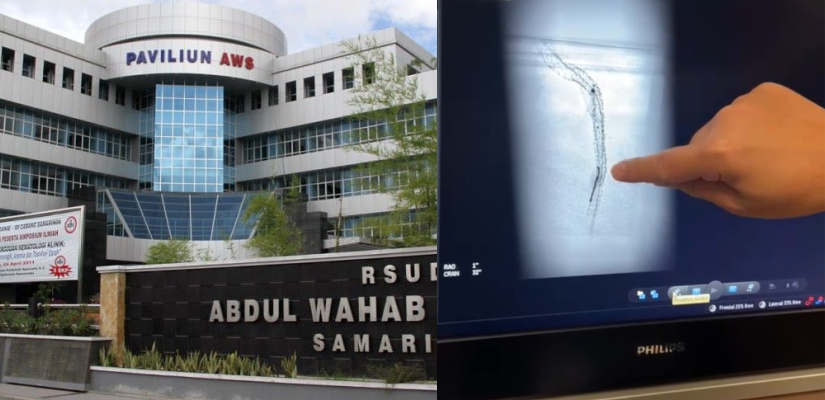 Terkait Kawat Tertinggal di Tubuh Pasien, RSUD AWS Minta Maaf dan Skorsing 6 Bulan Dokternya